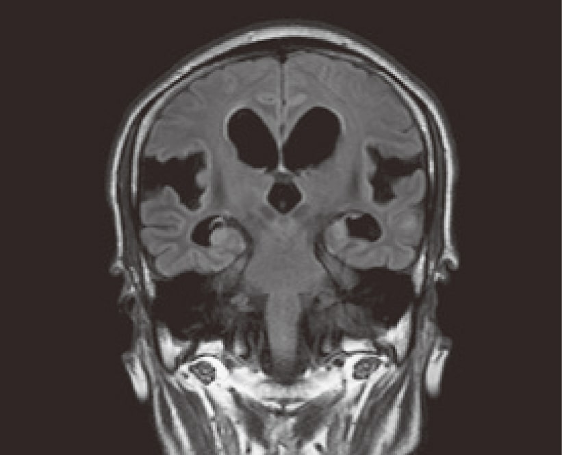 特発性正常圧水頭症MRI